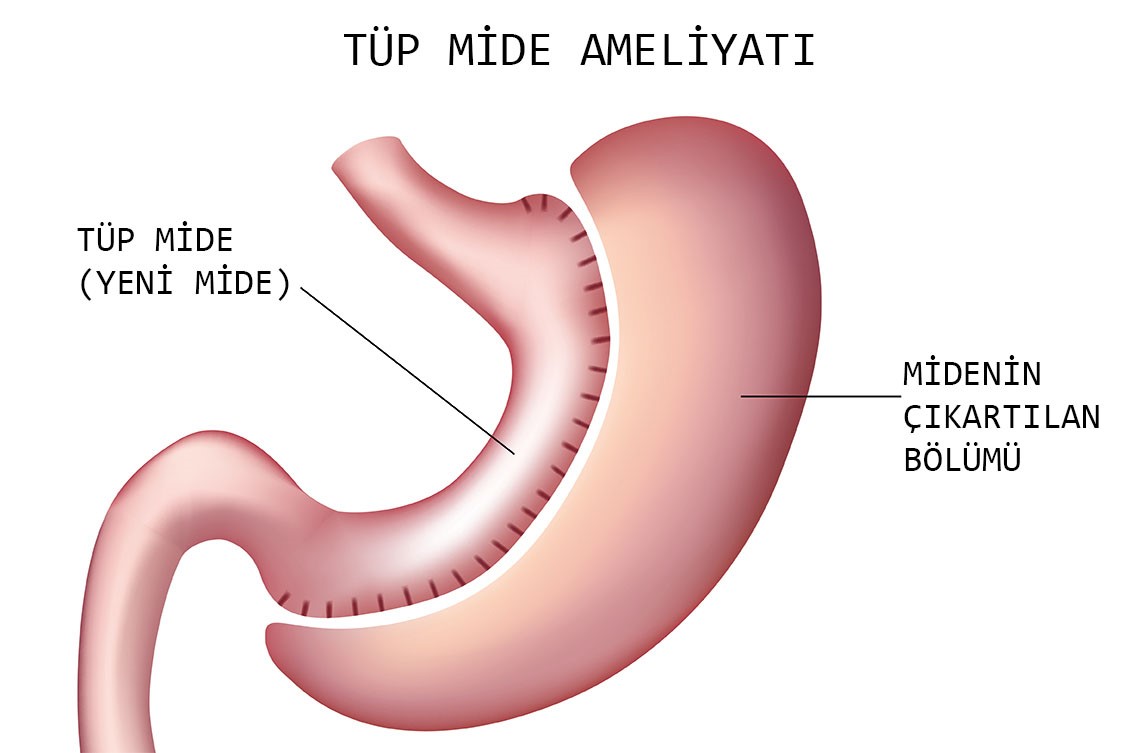 TÜP MİDE (SLEEVE GASTROCTEMY) AMELİYATI NEDİR?